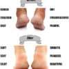 Full Heel Pain Anti-Crack Silicone Care Set
